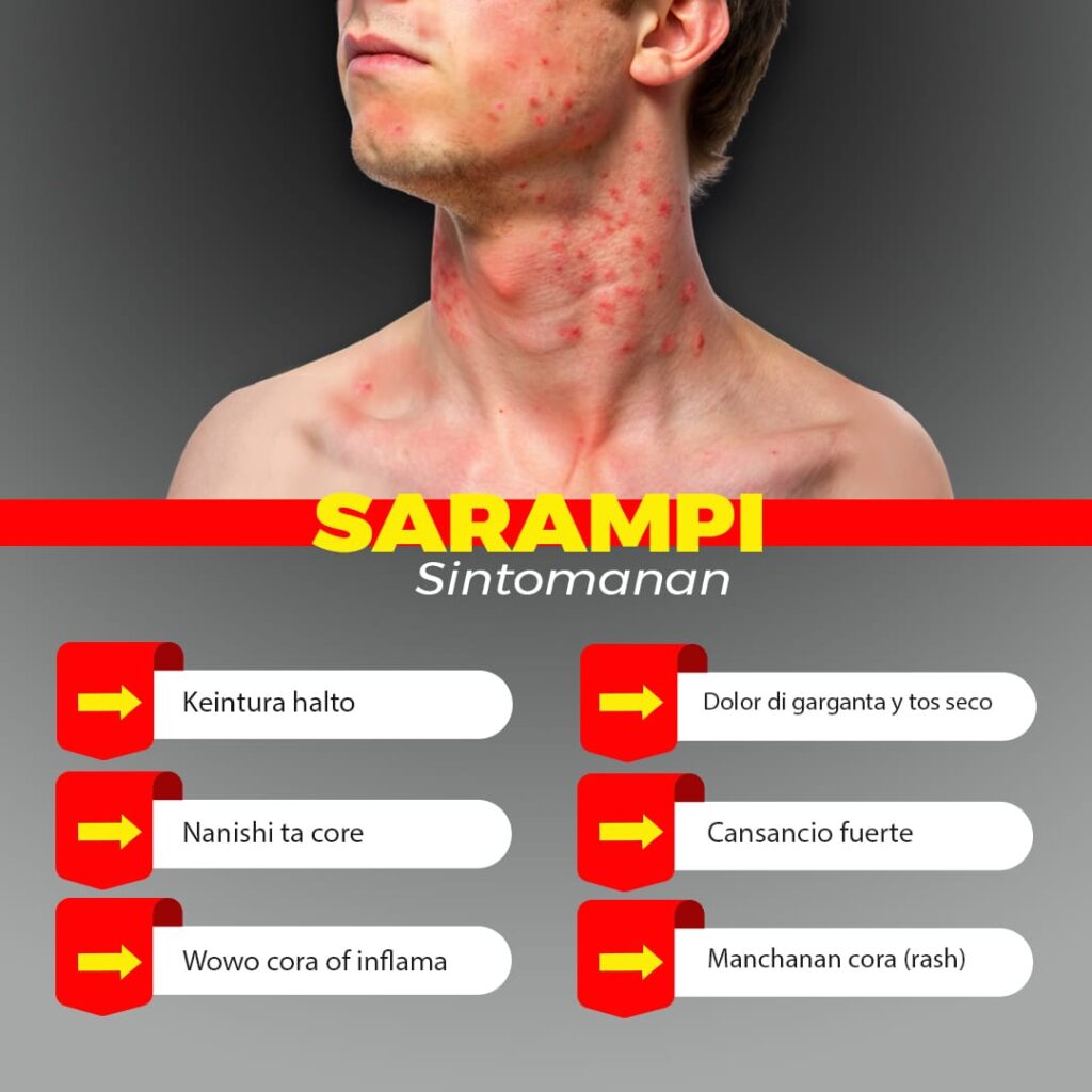 DVG ta informa Caso di Sarampi conoci na Boneiro tawata di transito na Aruba – Aruba Native