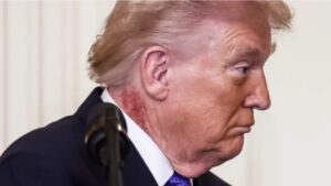 President Donald Trump a lanta preocupacionnan nobo tocante su salud debi na un rasca visible cu casca na su nek. – Aruba Native